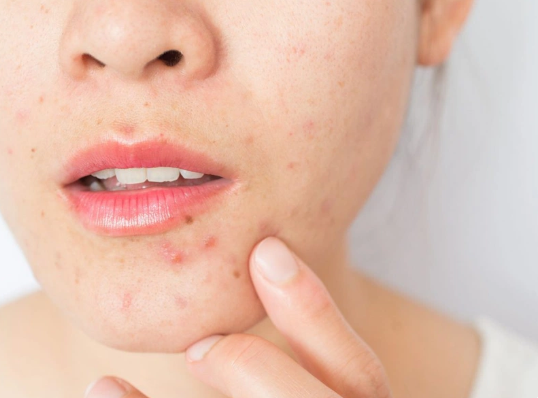 Ăn hạt điều có nổi mụn không Ăn hạt điều có nổi mụn không